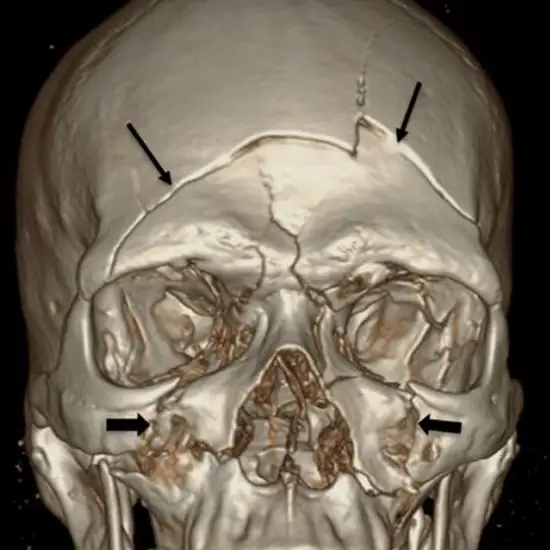 CT 3D Reconstruction Temporal Bone